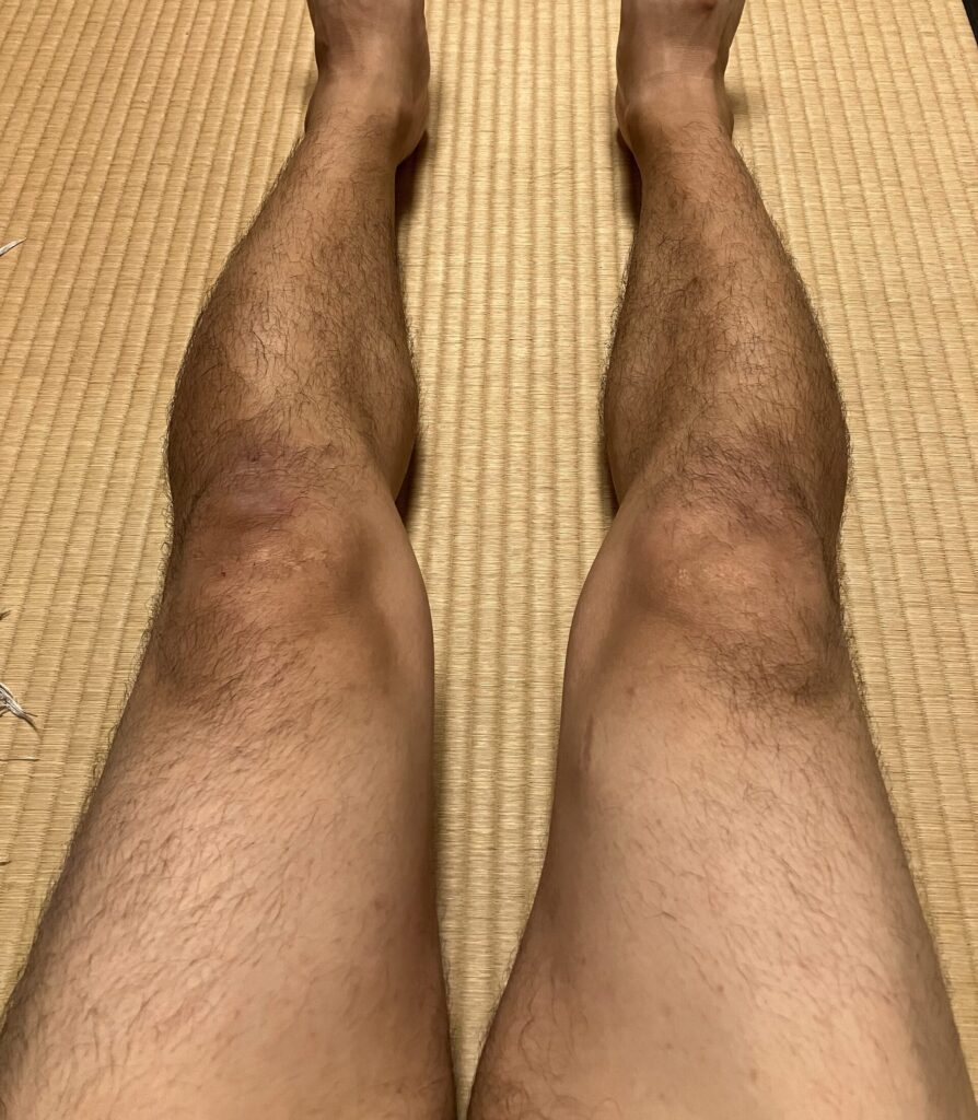 ケノン検証開始前の両脚のムダ毛｜46歳男性・剃毛前