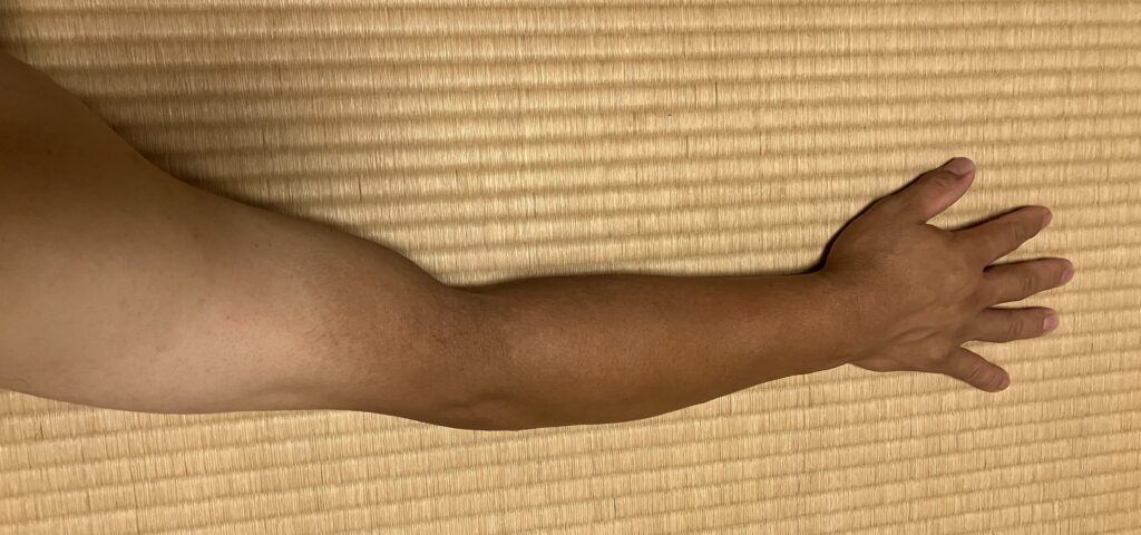 ケノン初回照射前の右腕｜剃毛後の状態