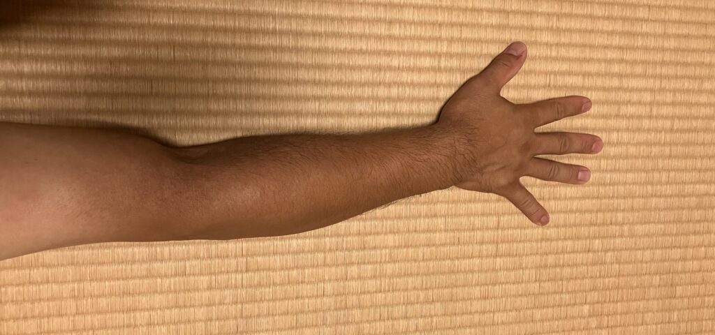 ケノン検証開始前の右腕のムダ毛｜46歳男性・剃毛前